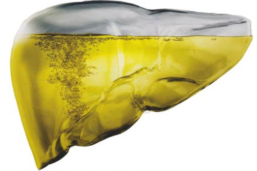 ¿Qué es el hígado Graso?