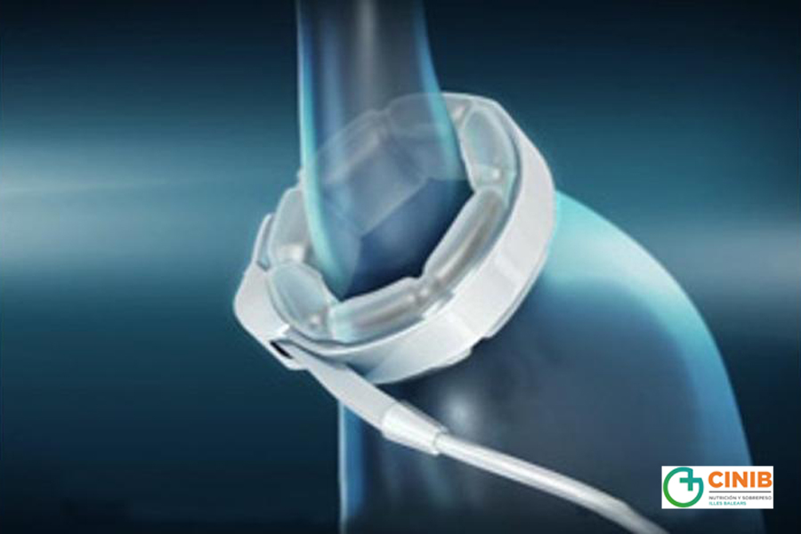 ¿Te pondrías una banda gástrica?