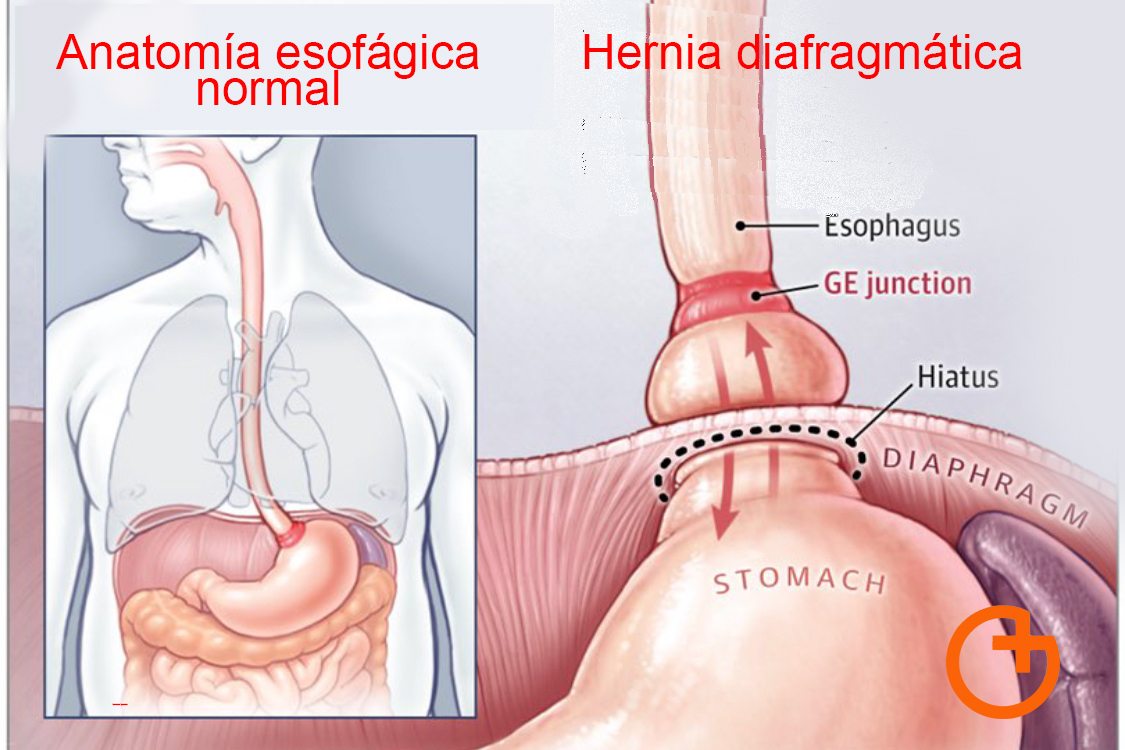 Reflujo gastroesofágico o hernia hiatal ¿Qué sabes del reflujo?