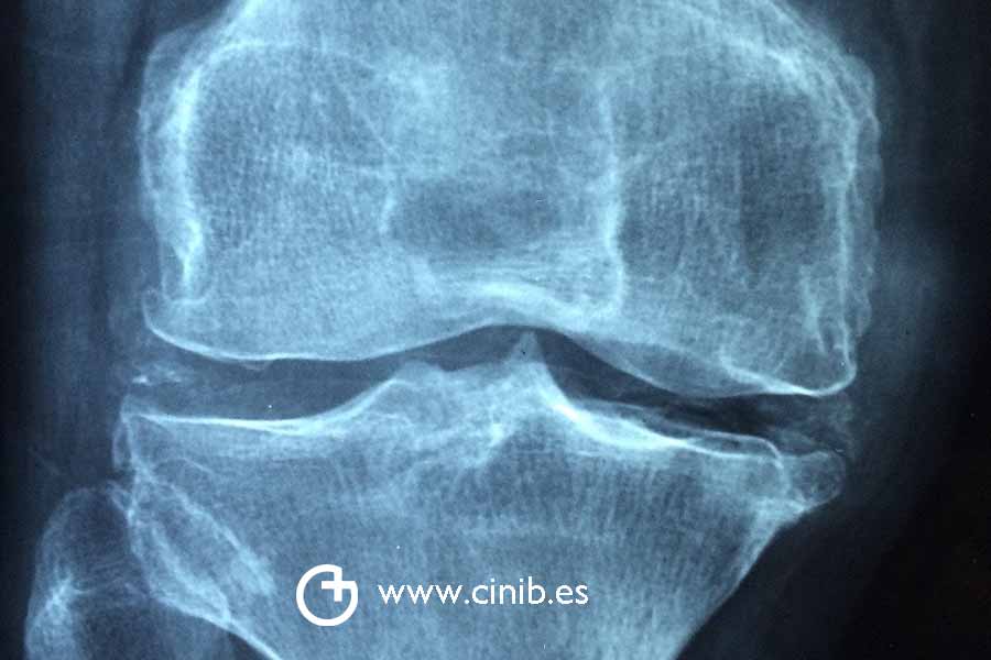 ¿La artrosis esta ligada a la obesidad?