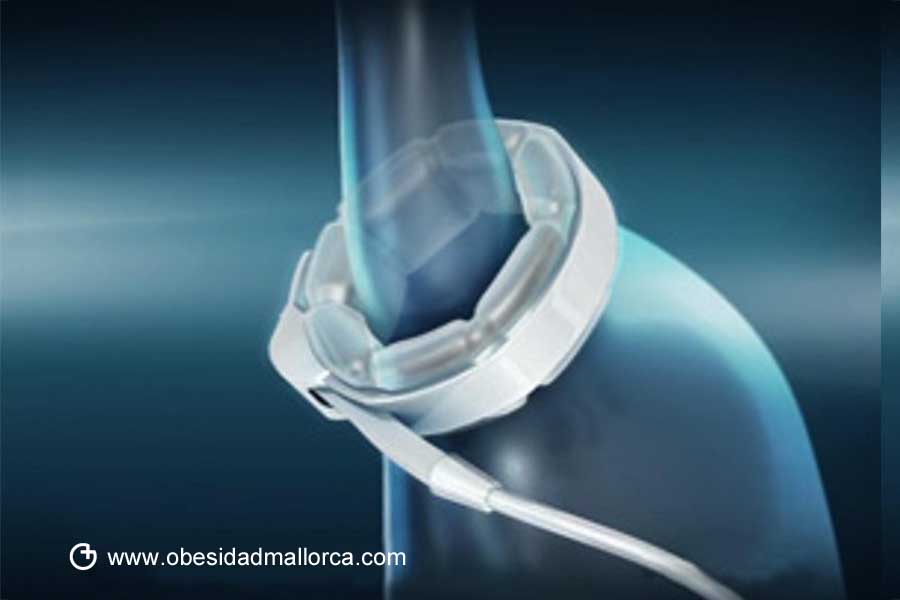 Banda gastrica, una opción quirúrgica caducada