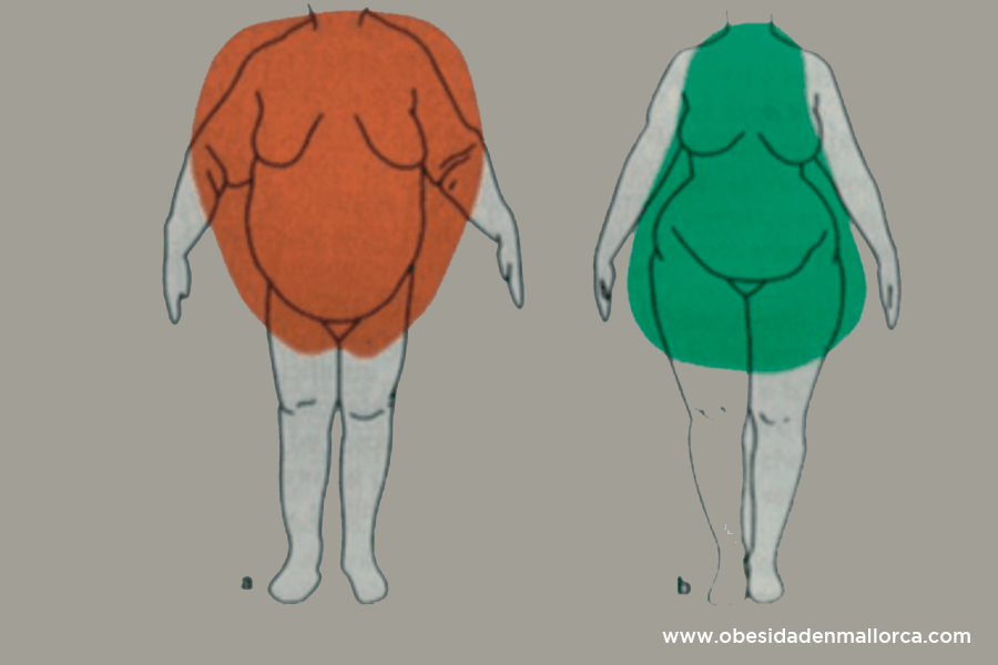Hay muchos tipos de obesidad, ¿cuál es importante para la salud?