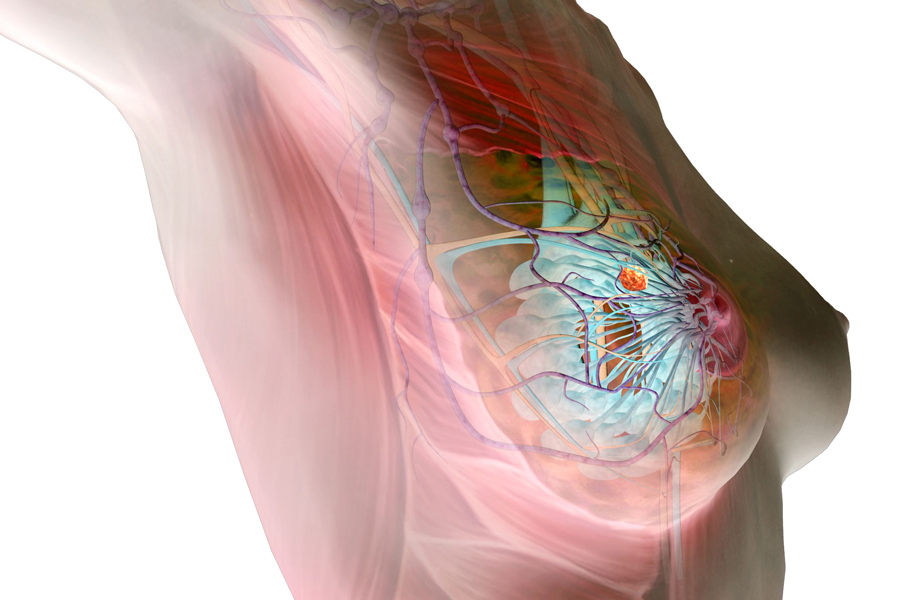 ¿Qué se sabe de la relación entre obesidad y cáncer de seno? 