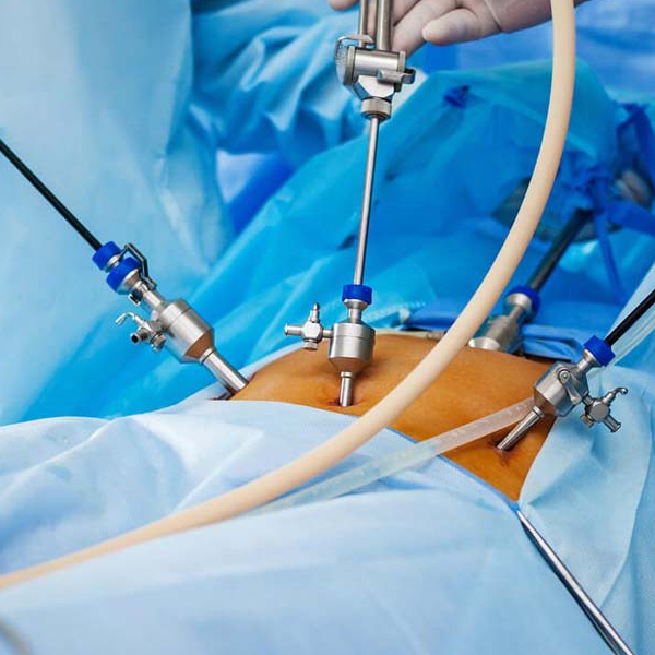 ¿Puedo operarme por laparoscopia sin abrir el abdomen?