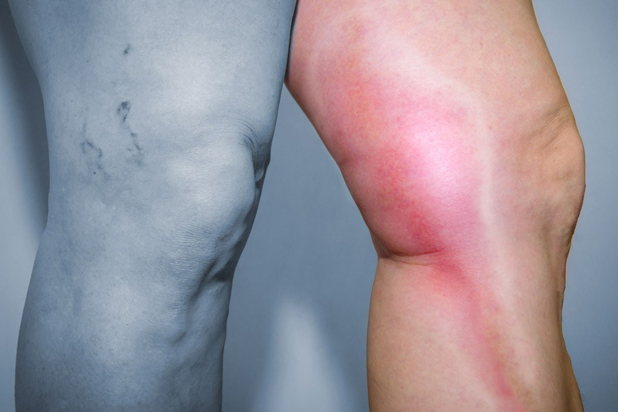 La enfermedad tromboembólica venosa